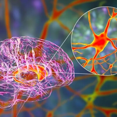 One-Time Gene Therapy Shows Lasting Promise Against Huntington’s Disease Four Years Later