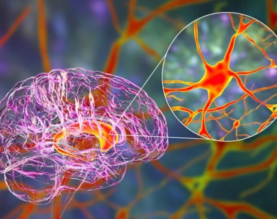 One-Time Gene Therapy Shows Lasting Promise Against Huntington’s Disease Four Years Later
